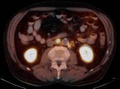 En bild tagen med CT-PET-teknik där man ser ett tvärsnitt i njurhöjd med två metastaser intill aorta