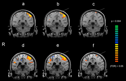 Figur 3 Funktionell MRI