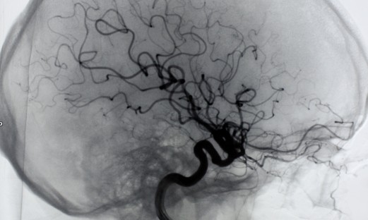 Kontraströntgen av hjärnans blodkärl
