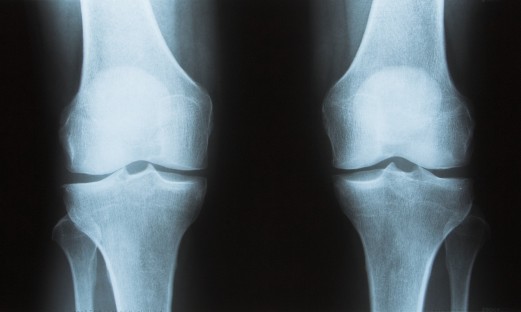 Röntgenbild knä