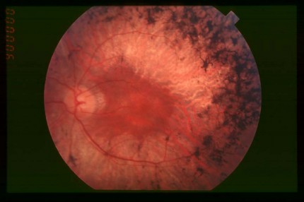 Retinitis pigmentosa