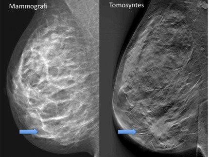 till vänster bröst undersökt med mammografi, till höger bröst undersökt med tomosyntes. Tumör är synlig endast med tomosyntes