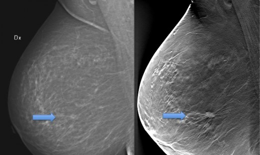 vänster bröst undersökt med mammografi, höger bröst med tomosyntes. Tumör synlig endast med tomosyntes