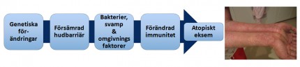 Utveckling av atopiskt eksem