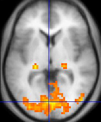 Funktionell MR-bild av hjärnan