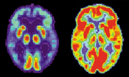 PET-bild av en hjärna hos en patient med Alzheimers sjukdom till vänster och en frisk hjärna till höger