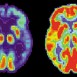 Ny roll för enzymer vid Parkinsons och Alzheimers