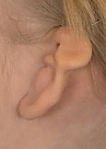 Missbildat öra före operation