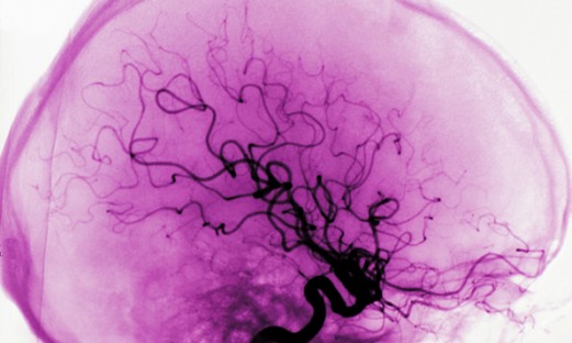 Arteriografi av hjärnans blodkärl