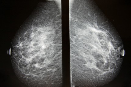 mammografibild av bröst