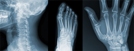 Röntgenbilder på nacke fot och hand