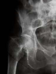 röntgenbild av höft