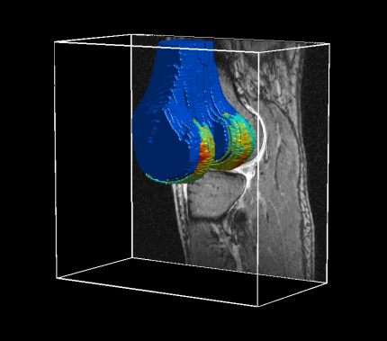 tredimensionell bild av brosk i knä med MR-kamera
