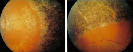 Retinitis Pigmentosa