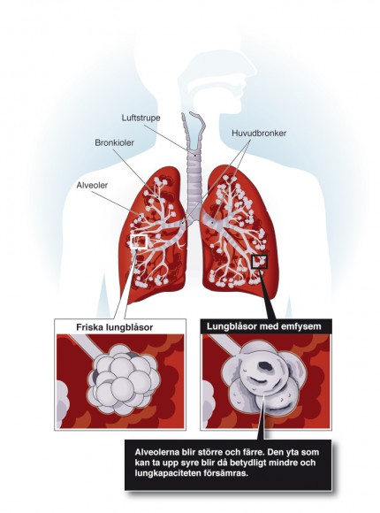 lungor angripna av KOL