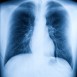 Risk för blodpropp vid autoimmuna sjukdomar