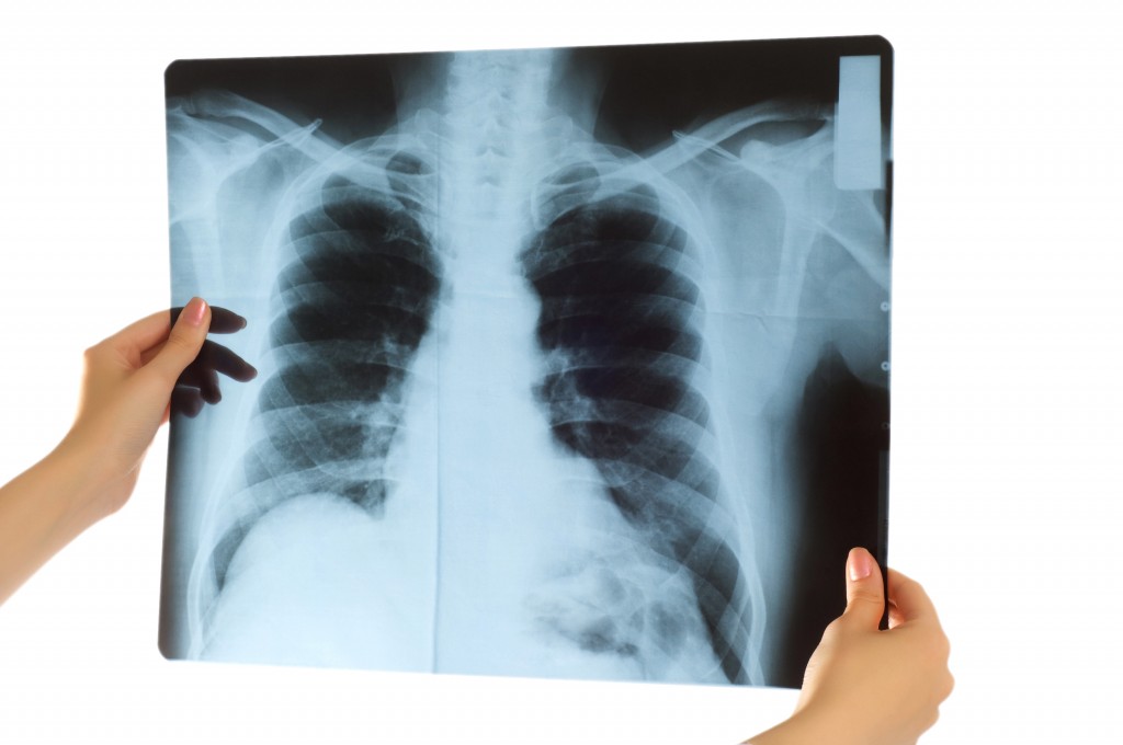 Röntgenbild av lungor