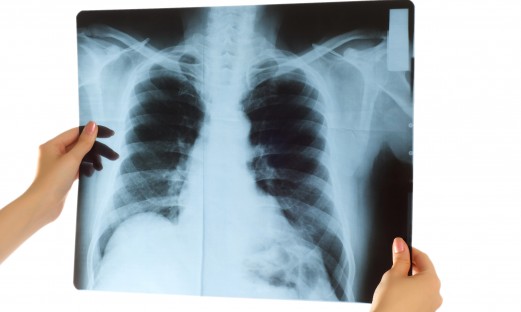 Röntgenbild av lungor