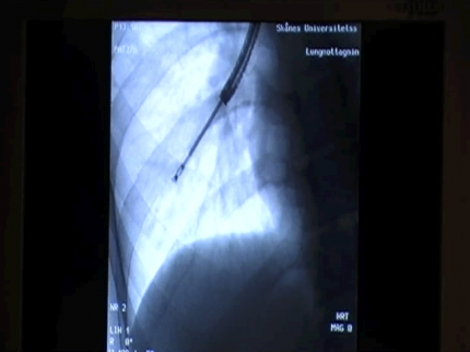 Genomlysning av lungan vid bronkoskopi