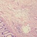 Nya möjligheter att oskadliggöra cancertumörer