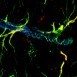 Blodkärl påverkas av behandling vid Parkinsons sjukdom