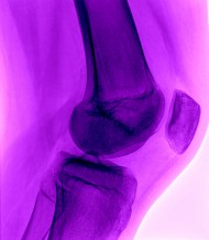 Röntgenbild av knä