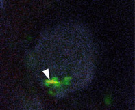 alpha-synucleininfekterad nervcell