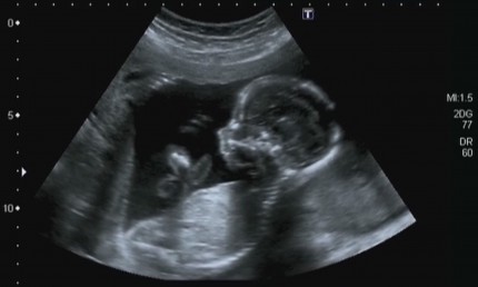 Ultraljud vid graviditet