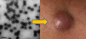 Merkel cell carcinoma