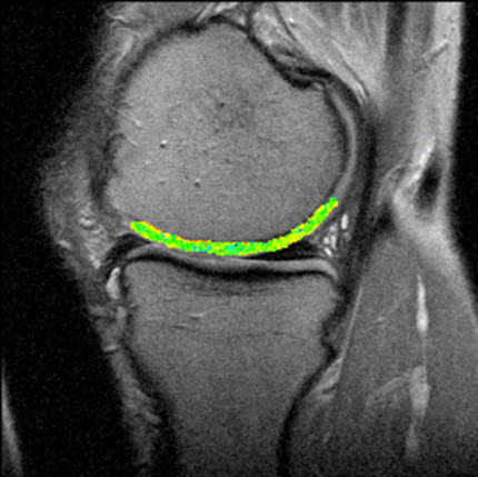 MR-bild av knä som visar broskkvalitet