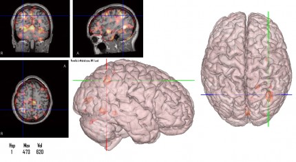Bild på hjärnan som visar var epilepsin är mest aktiv