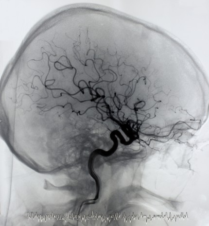 Arteriography of brain vessels classical radiology_dreamstime_8979970