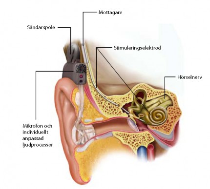 cochleaimplantat