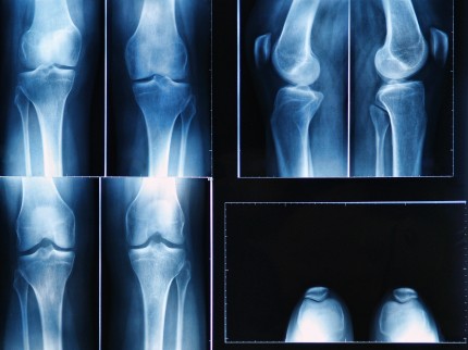 röntgenbild av knä