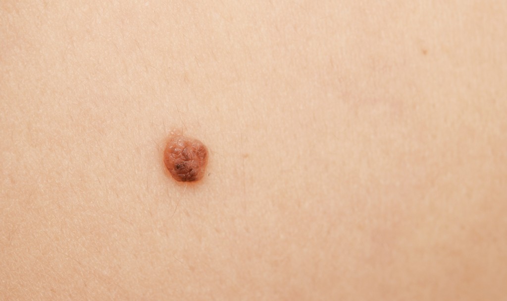mole
