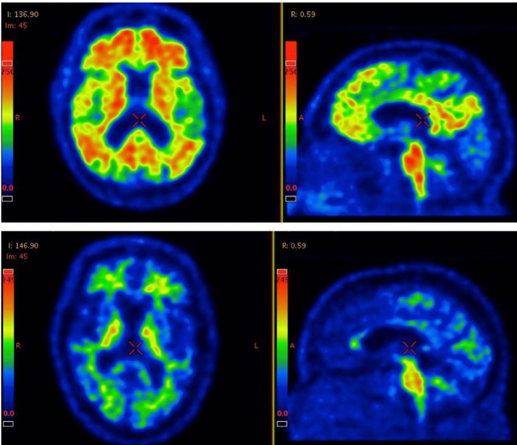 PET och MRI Feature