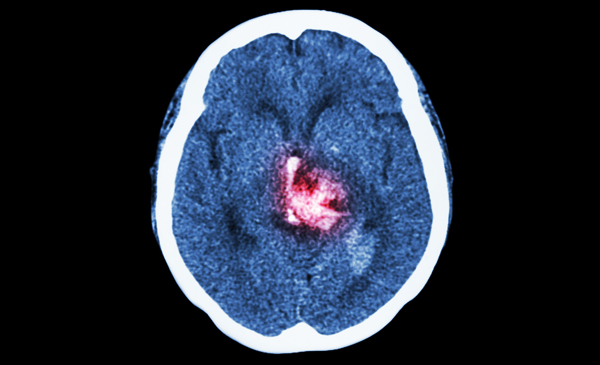 CT skanning stroke