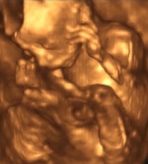 Ultrasonography Analysis of a 4th Month Fetus