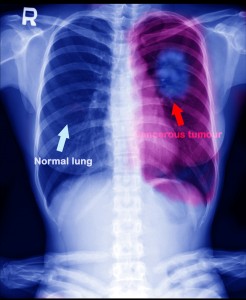 X ray of Lung cancer in women