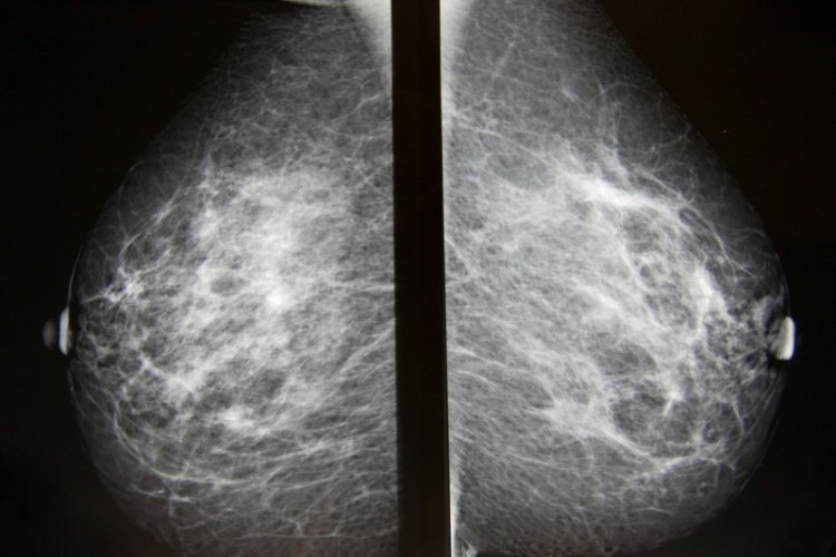 Digital mammography image, screening for breast cancer radiology both breasts_dreamstime_14088686