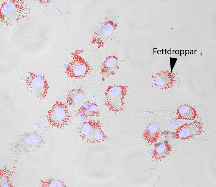 Lipid droplets GBM