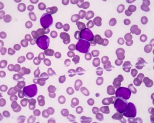 Blood smear show acute myeloblastic leukemia(AML).The smear shows large number of cancer leukemia cells (large blue cells) with the smaller red to pink normal red blood cells or erythrocytes.