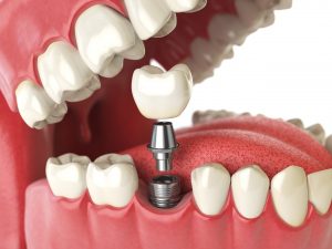 Tooth human implant. Dental concept. Human teeth or dentures. 3d illustration