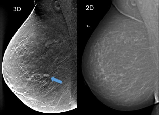 Bilden jämför två mammografibilder, den ena med 3D-teknik, den andra i 2D