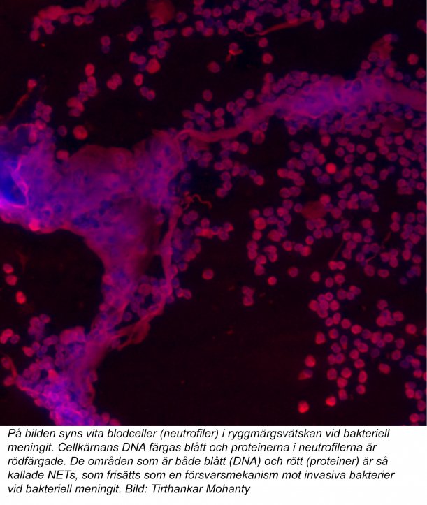 Vita blodceller (netrofiler) i ryggmärgsvätskan vid bakteriell meningit