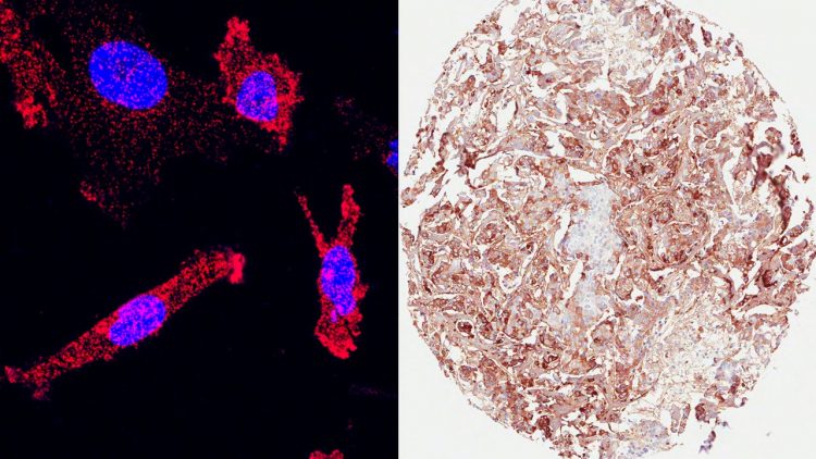 Vänstra bilden: Bröstcancerceller där kärnorna är blå och varje röd punkt motsvarar interaktion mellan COMP och protein som gör dessa mer aggressiva. Högra bilden: Patientens bröstcancerceller där forskarna färgat in det protein de forskar på (COMP).