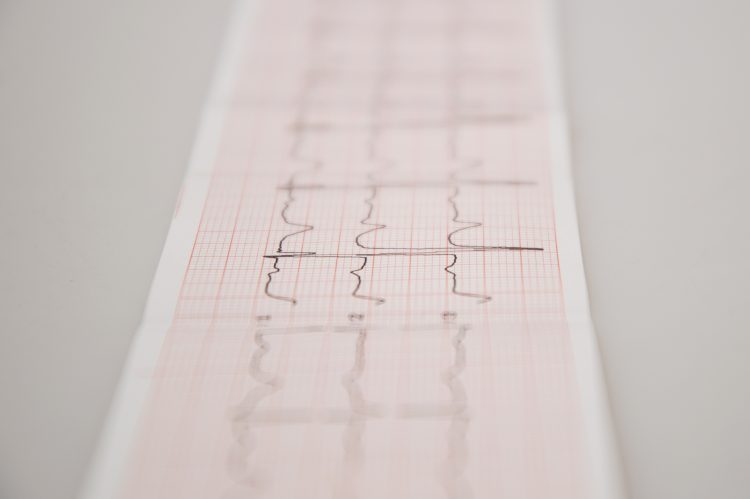 EKG. Foto: iStock/Maryna Ievdokimova