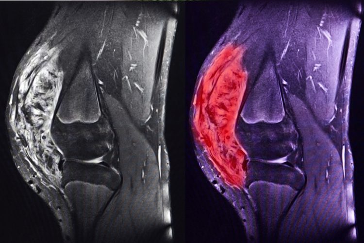 Bild på knäsarkom, tagen med MRI.