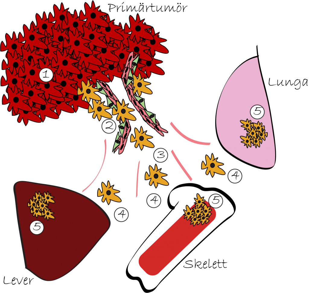 Illustration över hur cancerceller sprider sig från primärtumören vidare till organ i kroppen.