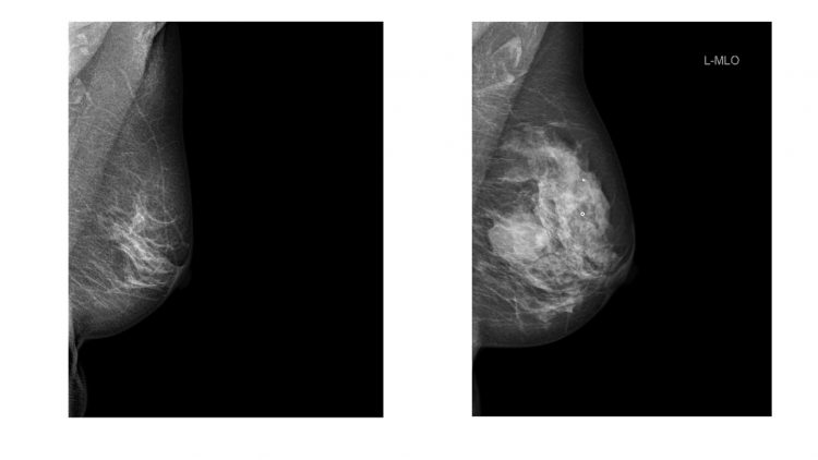 Mammografibild av bröst. Det ena bröstet uppvisar ganska lite täthet, dvs ganska få vita fläckar på röntgenbilden och det andra bröstet ganska mycket täthet, dvs många vita fläckar på bilden. Copyright Sophia Zackrisson. 